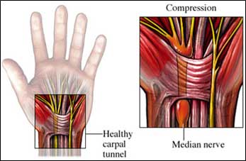 an illustration of a hand with a healthy carpal tunnel and one with a swollen median nerve