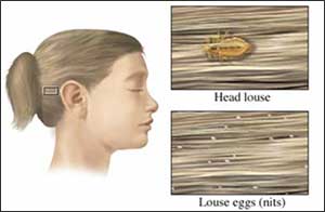 an illustration of a head louse and louse eggs in a child's hair