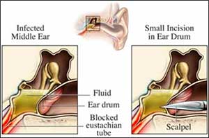 illustration showing a scalpel cutting into the ear to release fluid