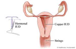 a hormonal IUD or copper IUD can be inserted into the uterus