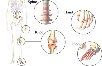 the spine, hand, knee, and foot can be affected by osteoarthritis