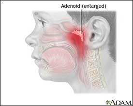 an illustration of a child with an enlarged adenoid near their ear