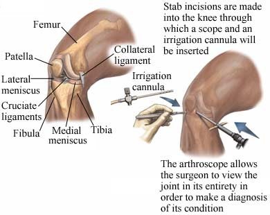 incisions are made into the knee so a scope can be inserted and the surgeons can view the joint to make a diagnosis