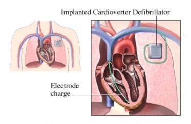 the implanted cardioverter defibrillator is inserted near the heart and an electrode charge is inside the heart