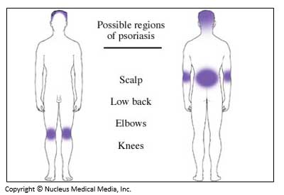 Possible regions of psoriasis include scalp, low back, elbows and knees