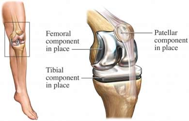 knee replacements include femoral, tibial, and patellar components