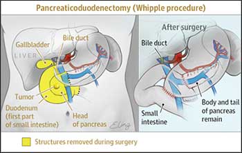 whipple procedure animation