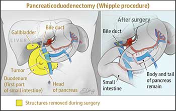 whipple procedure for pancreatitis