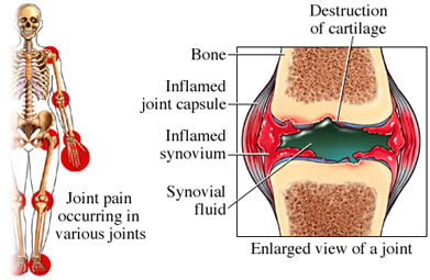 joint pain occurs when cartilage is damaged and the joint becomes inflamed
